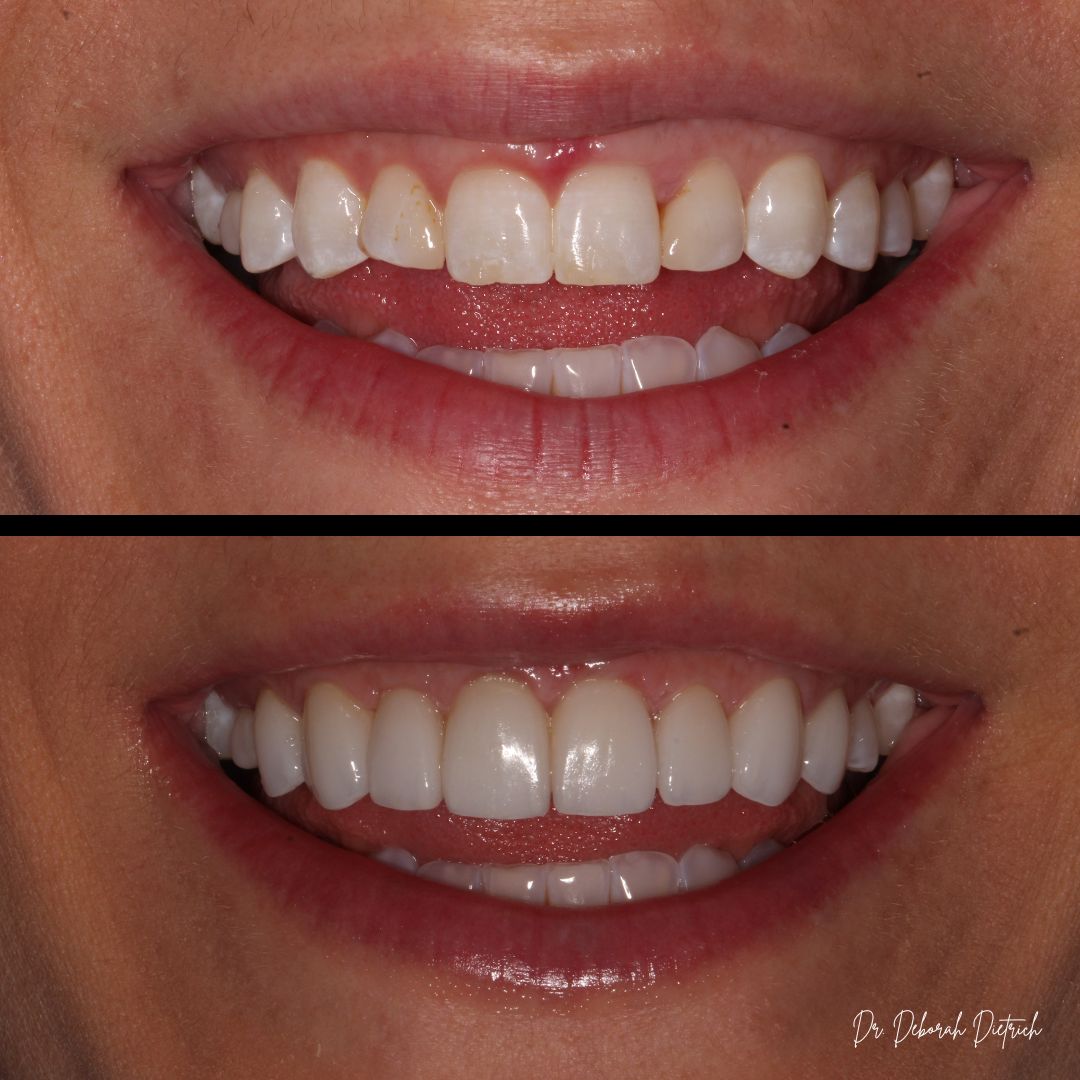 Plaza Dental Group Urbandale - Porcelain Veneers before and after Veneers plaza dental (4)