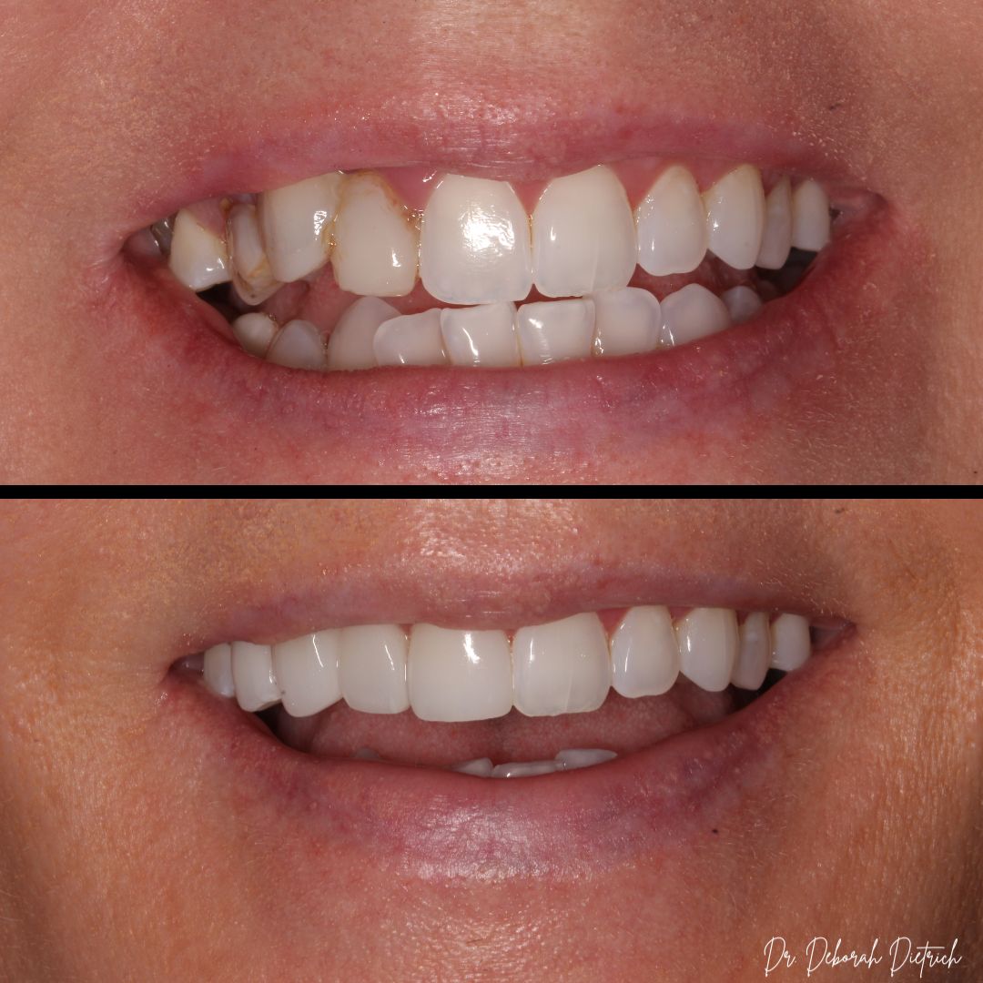 Plaza Dental Group Urbandale - Porcelain Veneers before and after Veneers plaza dental (4)