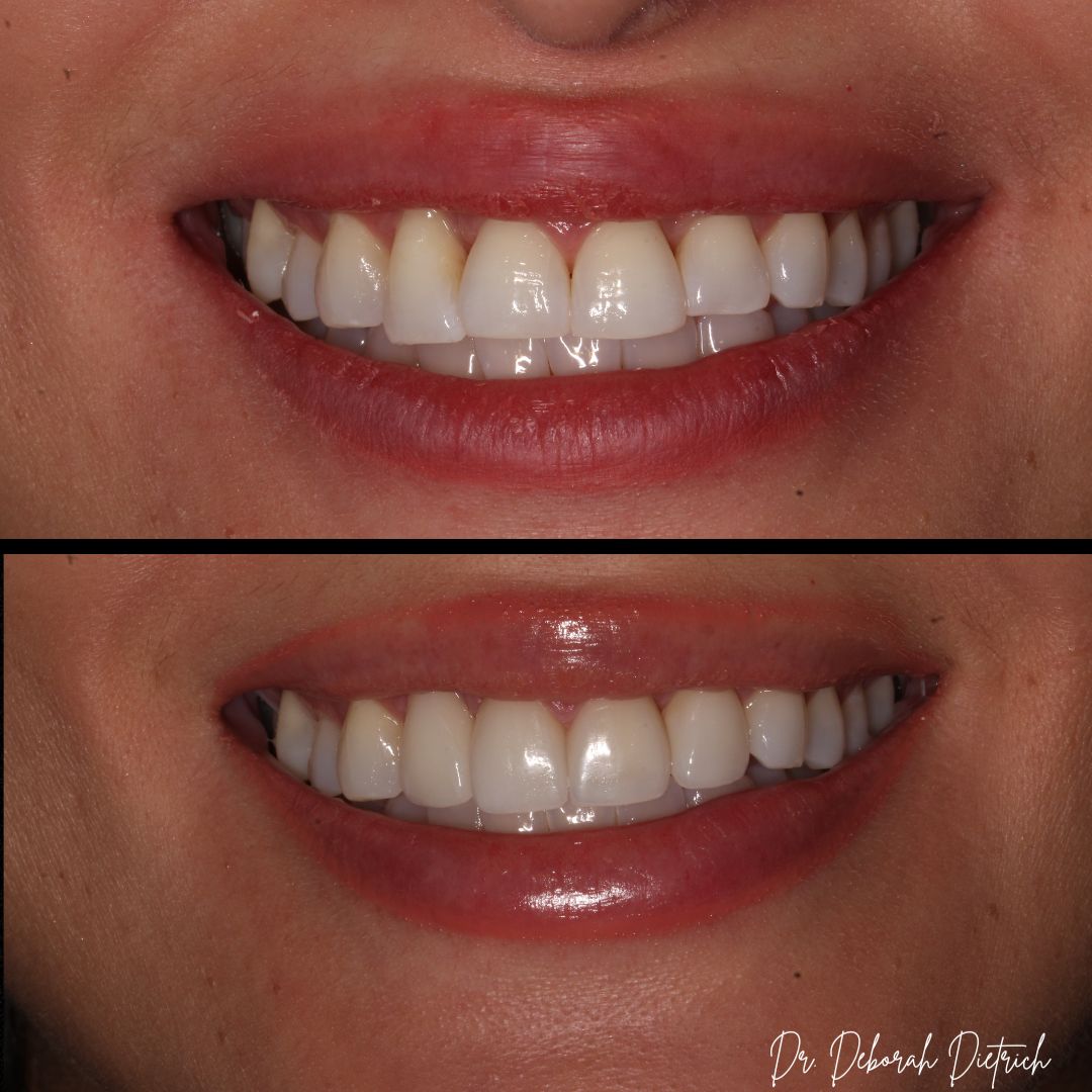 Plaza Dental Group Urbandale - Porcelain Veneers before and after Veneers plaza dental (4)