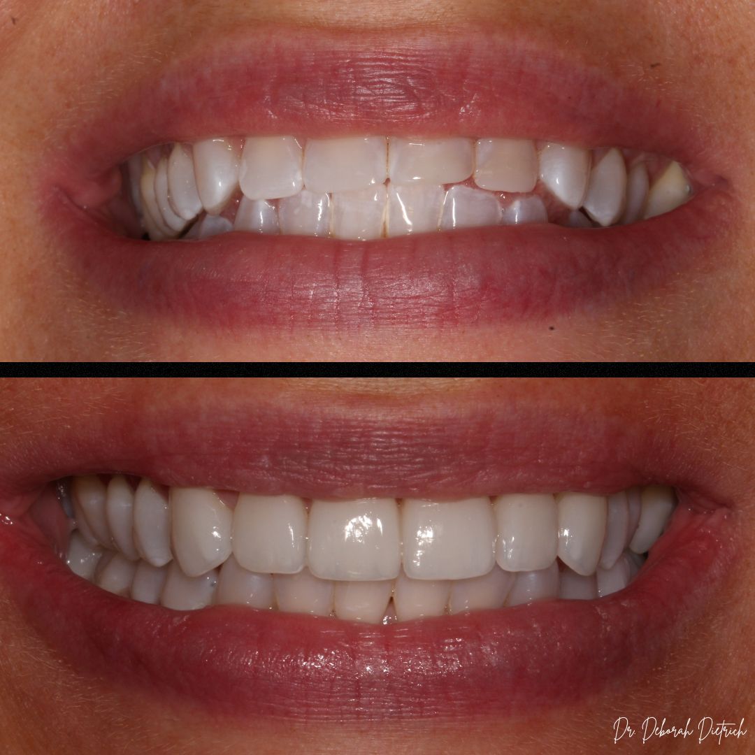 Plaza Dental Group Urbandale - Porcelain Veneers Plaza Dental Group Urbandale - Porcelain Veneers