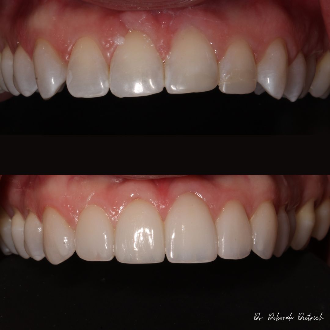 Plaza Dental Group Urbandale - Porcelain Veneers before and after Veneers plaza dental (4)